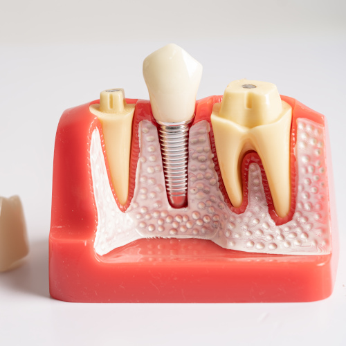 Implants dentaire Sartrouville